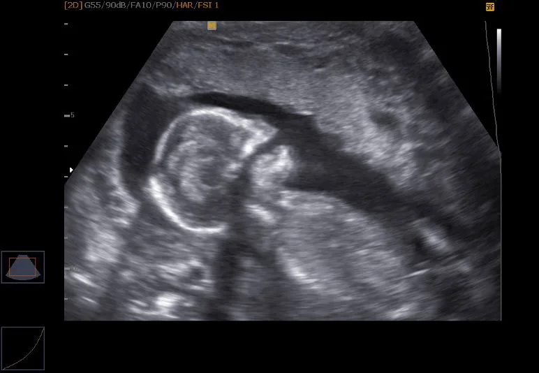 Persistent flame Gather Analiza cu ultrasunete a sarcinii - Patuturi pentru bebelusi