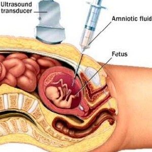 Tratament Deficienta De Fluid Amniotic