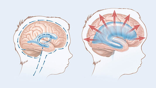 Hidrocefalia Presiune In Creier