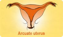 Arcuate Uterus