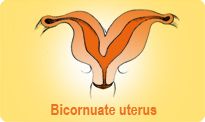 Bicornuate Uterus